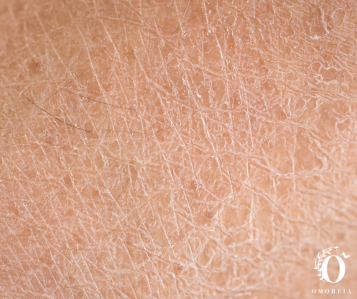 První pomoc pro poškozenou kožní bariéru